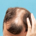 Lifestyle Factors and Male Pattern Baldness: What You Need to Know