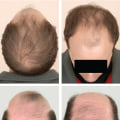 Diagnosing Male Pattern Baldness: All You Need to Know