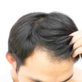 Scalp Treatments for Hair Growth: Tips and Techniques