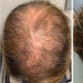 All About Minoxidil: A Comprehensive Guide to Hair Loss Treatment