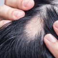 Understanding Alopecia: Causes, Treatments, and Management