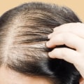 Lifestyle Factors and Female Hair Loss: What You Need to Know