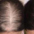 Natural Remedies for Female Hair Loss