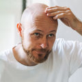 Genetics and Male Pattern Baldness: Understanding the Causes and Risks