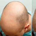 Understanding Hair Transplants: A Comprehensive Guide