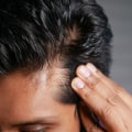 Understanding Low-Level Laser Therapy for Hair Loss