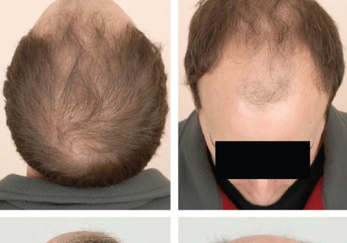 Diagnosing Male Pattern Baldness: All You Need to Know