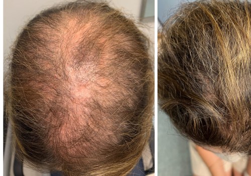 All About Minoxidil: A Comprehensive Guide to Hair Loss Treatment