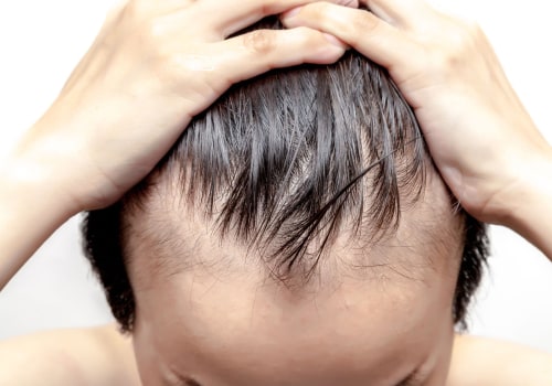 Understanding Male Pattern Baldness: What You Need to Know