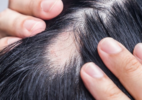 Understanding Alopecia: Causes, Treatments, and Management