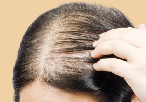 Lifestyle Factors and Female Hair Loss: What You Need to Know