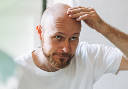 Genetics and Male Pattern Baldness: Understanding the Causes and Risks