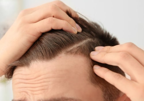 Understanding Finasteride for Hair Loss: A Comprehensive Guide