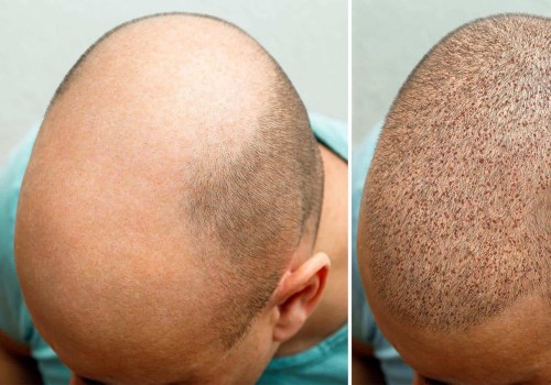 Understanding Hair Transplants: A Comprehensive Guide