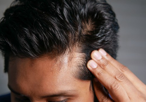 Understanding Low-Level Laser Therapy for Hair Loss