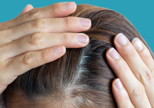 Iron-deficiency Anemia and Hair Loss: Understanding the Connection